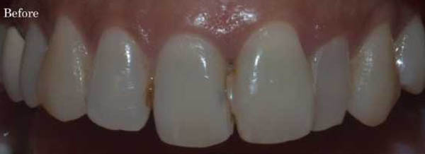 Before