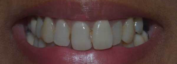 Before