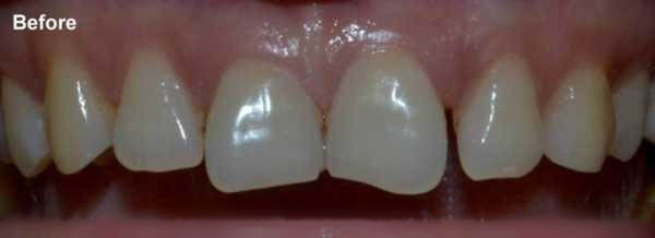 Before