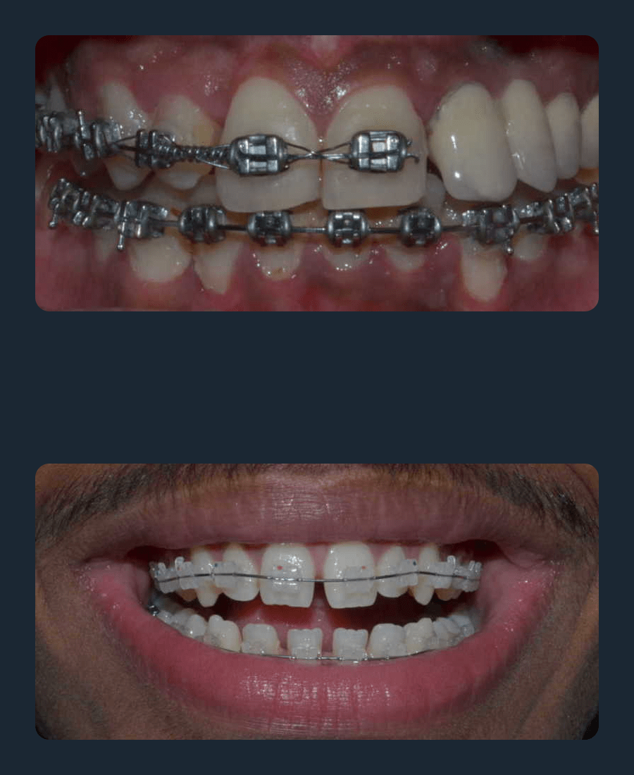 braces-min